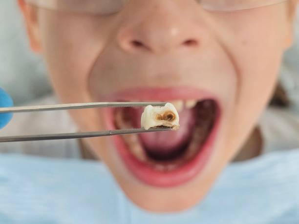 Best Emergency Tooth Extraction in Richfield, MN